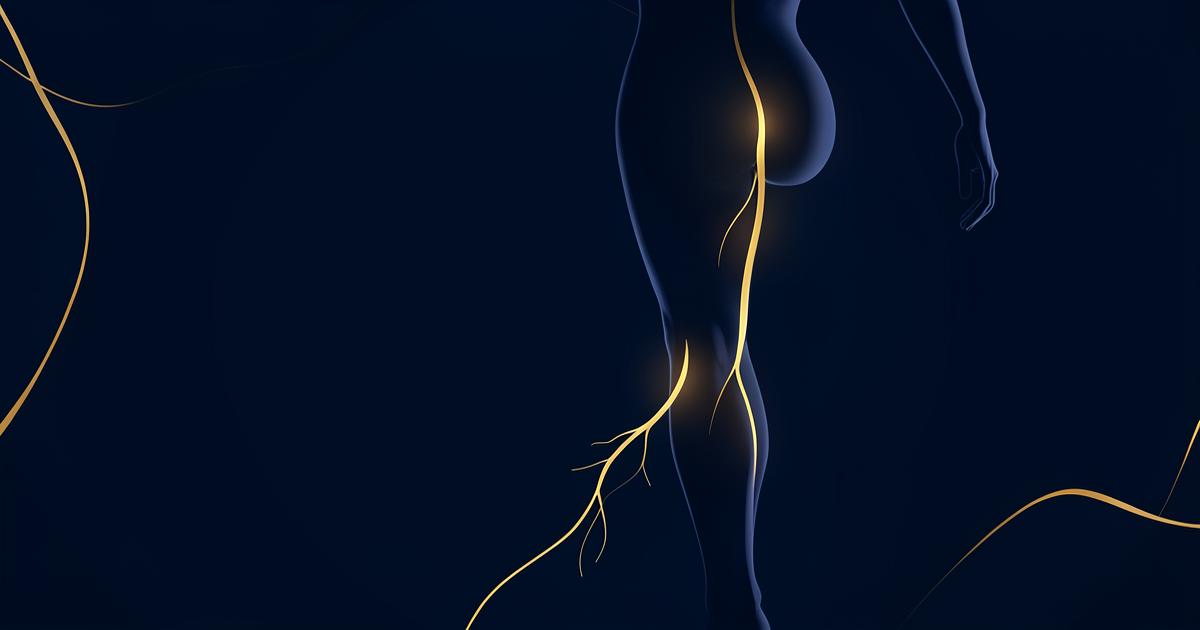 Quanto dura la sciatalgia e perché a volte non passa